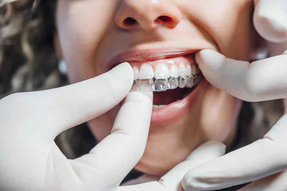 Tips for Maintaining Your Invisalign Aligners 